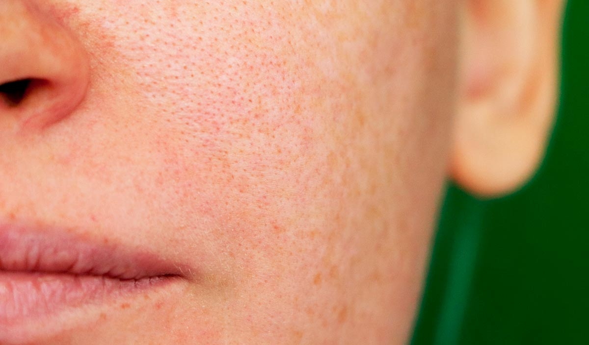 Kann man vergrösserte Poren verkleinern?